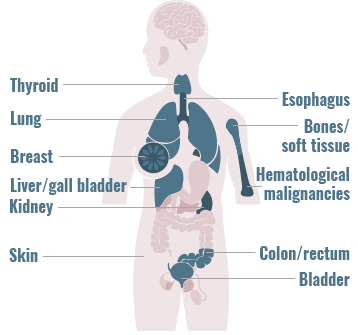 Distribution of ALK gene fusions across primary tumor sites graphic